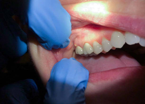 Best Emergency Dental Care for Abscessed Tooth in Nashville, GA